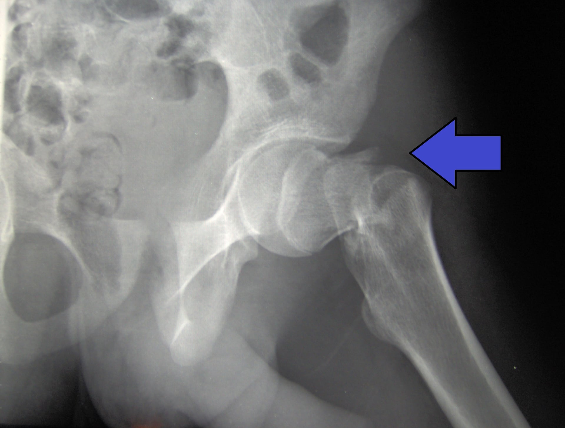 AP hip radiograph showing a fracture of the femoral neck marked by an arrow.