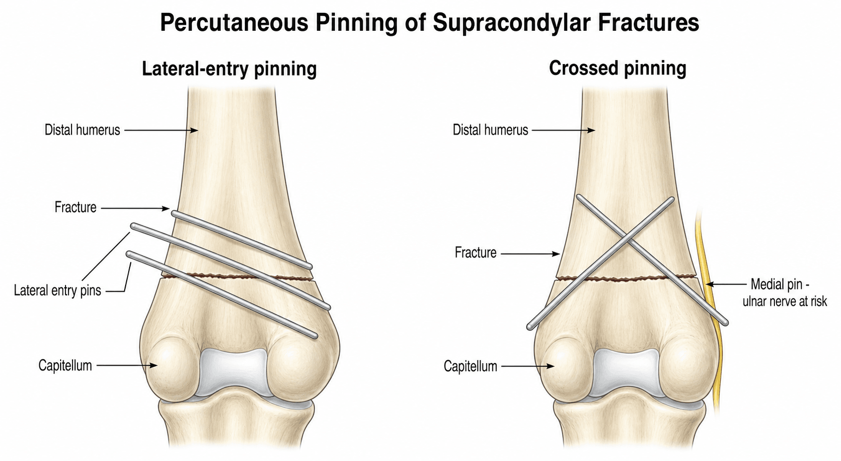 Diagram of lateral-entry versus crossed percutaneous pinning of a supracondylar humerus fracture, showing the ulnar nerve at risk from a medial pin.