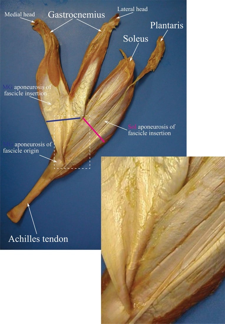 Cadaveric dissection of the triceps surae showing the gastrocnemius (medial and lateral heads), soleus, plantaris, their aponeuroses and the Achilles tendon.