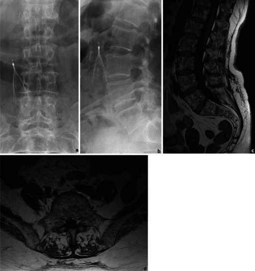 Lumbar spine radiographs and T1-weighted MRI showing diffuse osteopenia in an elderly woman with multiple myeloma.