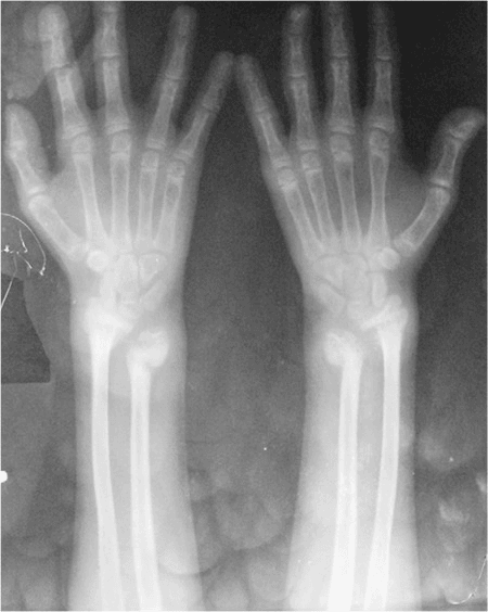 Radiograph of both hands and forearms showing osteopenia and cupped, frayed, splayed distal radial and ulnar metaphyses.