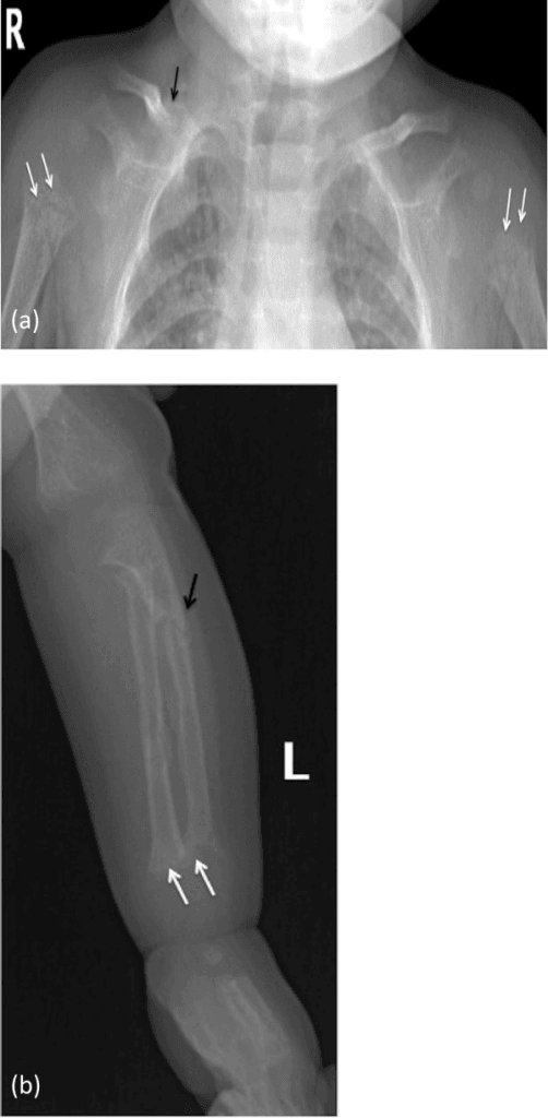 Radiographs of the upper limb showing generalised osteopenia with frayed, lucent humeral and forearm metaphyses.