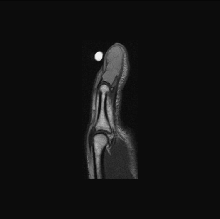 Preoperative sagittal T1 MRI of thumb distal phalanx showing expansile lytic lesion