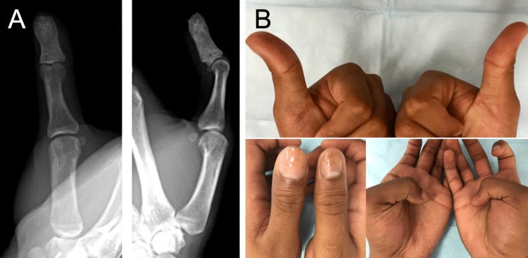 Postoperative radiograph and clinical picture of thumb following curettage and bone grafting