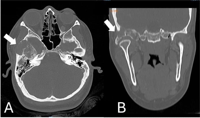Preoperative CT and MRI of cranial giant cell reparative granuloma