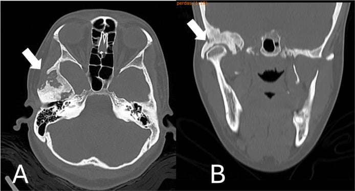 Follow-up CT and MRI demonstrating lesion sclerosis and regression following denosumab therapy