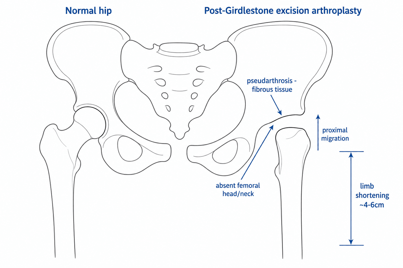 Schematic comparing a normal hip to the post-Girdlestone excision arthroplasty appearance, showing absent femoral head/neck, proximal migration, fibrous pseudarthrosis, and limb shortening