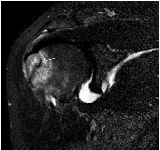 Fat-suppressed MRI of an occult greater tuberosity fracture of the shoulder
