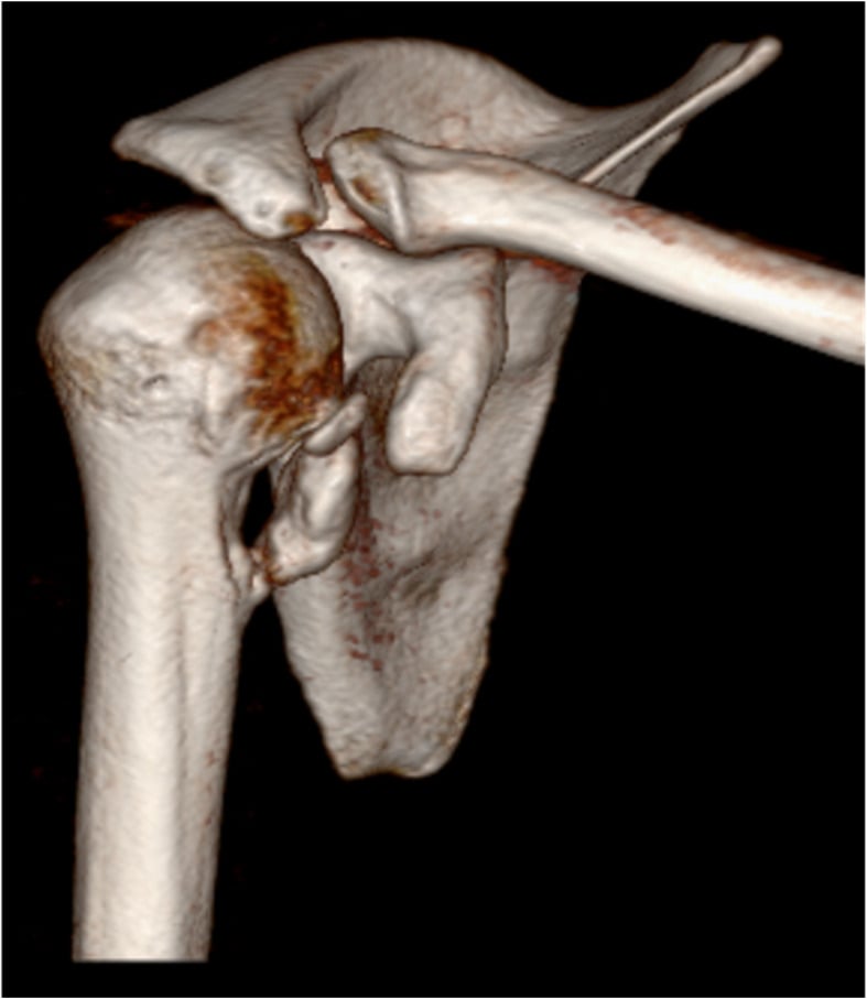 3D CT reconstruction showing a displaced greater tuberosity fracture of the proximal humerus