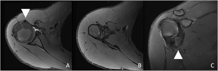 Axillary and coronal MRI showing a greater tuberosity avulsion fracture and biceps tendon subluxation