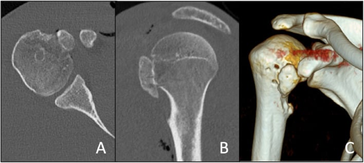 Axial, sagittal and 3D CT images showing postoperative reduction and fixation of a greater tuberosity fracture