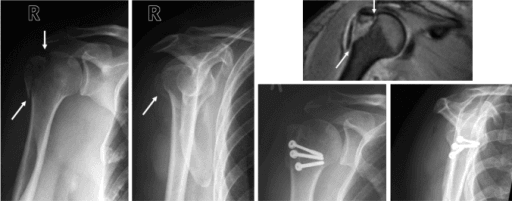 Preoperative and postoperative radiographs showing cannulated screw fixation of a greater tuberosity fracture