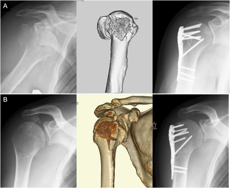Radiographs of a proximal humeral fracture-dislocation before and after plate fixation