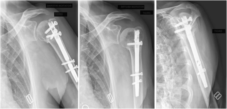 Postoperative anteroposterior and lateral radiographs showing intramedullary nail fixation of the proximal humerus