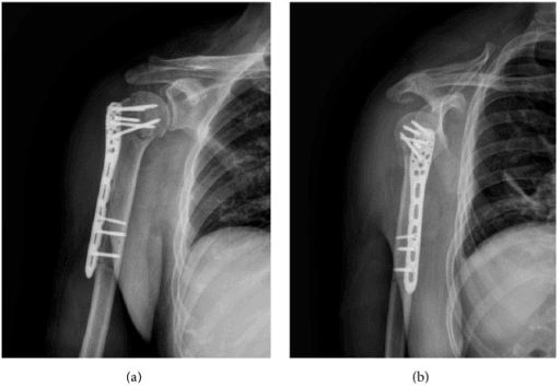 Anteroposterior and lateral radiographs showing locking plate fixation of a 2-part greater tuberosity fracture