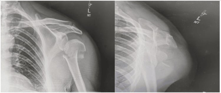 Anteroposterior and Scapular Y radiographs showing a displaced proximal humerus fracture-dislocation