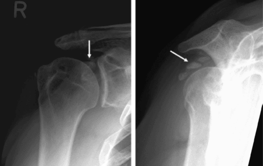 Multi-view radiographic assessment of GT fracture
