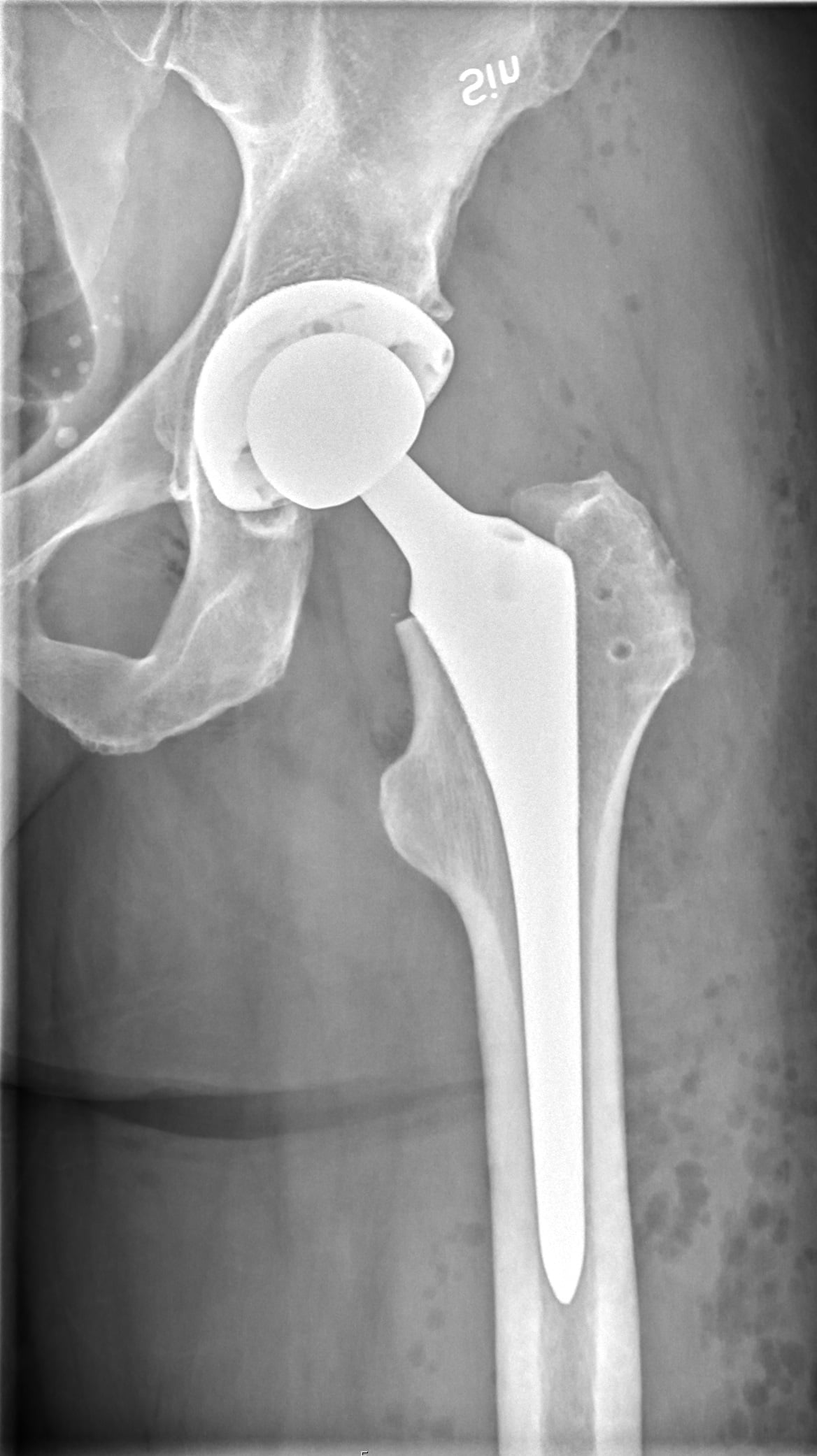 AP radiograph of a total hip arthroplasty showing the femoral stem in the proximal femur.