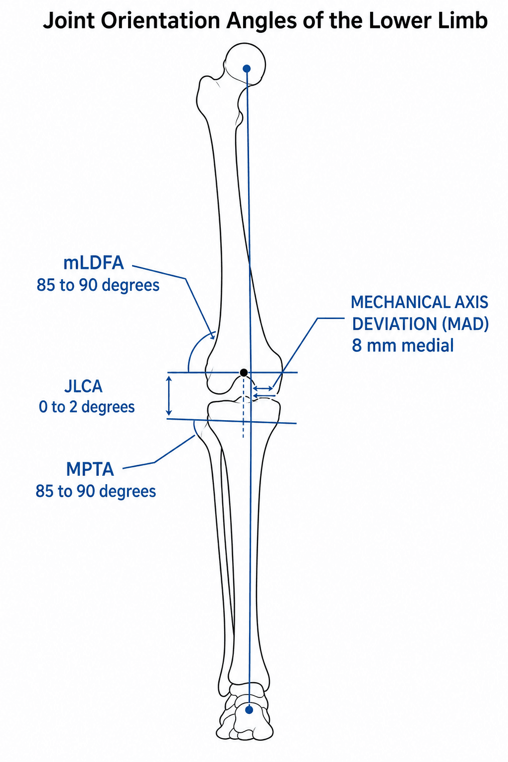 Full-length lower-limb schematic of the joint-orientation angles with normal values: mechanical axis deviation (MAD), mLDFA at the distal femur, MPTA at the proximal tibia and JLCA at the knee joint line.