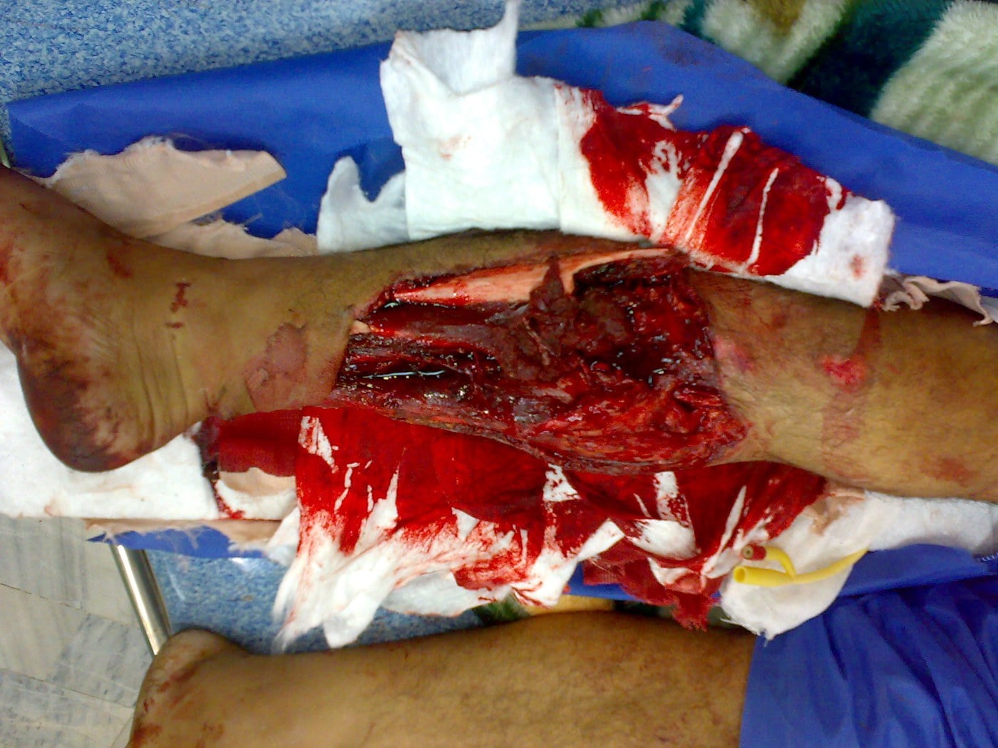 Clinical photograph of a high-grade open tibial fracture: a large anterior leg wound with exposed bone and extensive soft-tissue loss.