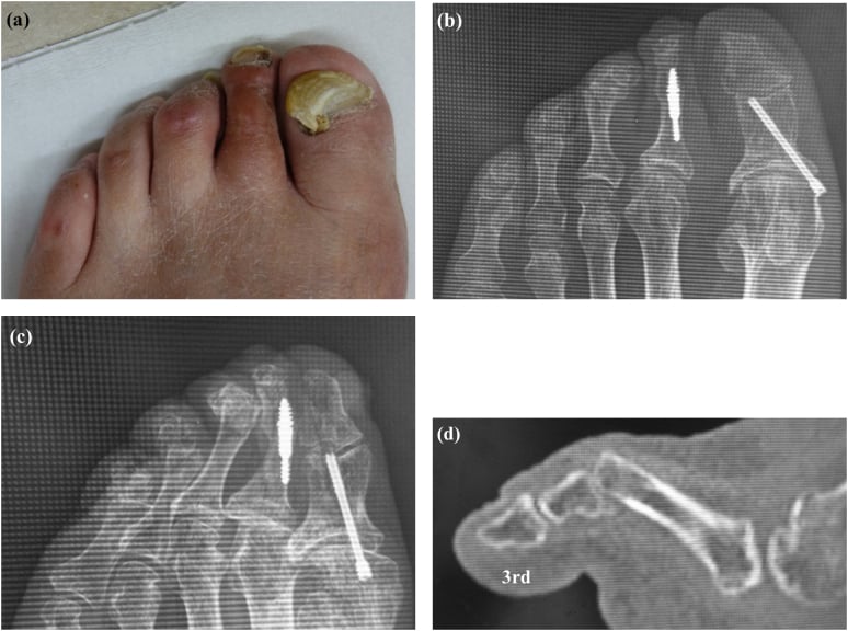Clinical photograph, forefoot radiographs and sagittal CT of lesser-toe deformities, with an intramedullary implant already in one lesser toe