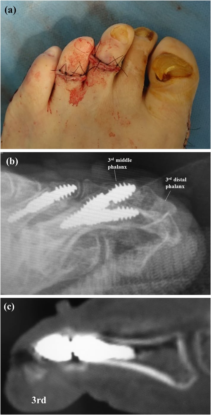 Sutured toe incisions, radiograph and sagittal CT showing intramedullary implants in lesser toes