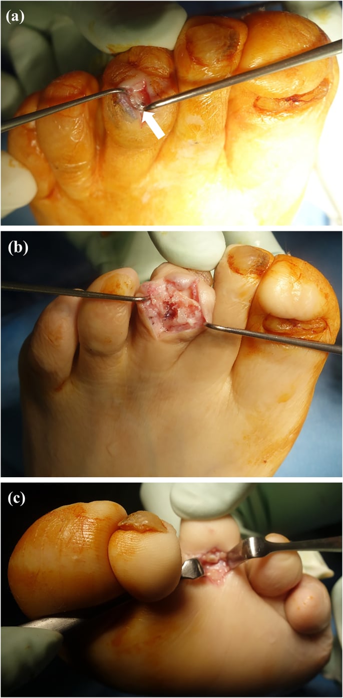 Removal of an eroding intramedullary implant with flexor tenotomy