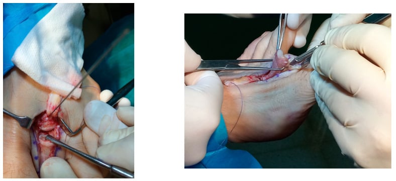 Weil osteotomy fixation and distal FDL release for instability-driven hammer toe