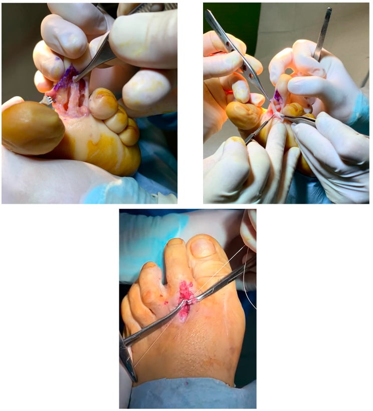 Flexor digitorum longus transfer for flexible hammer toe