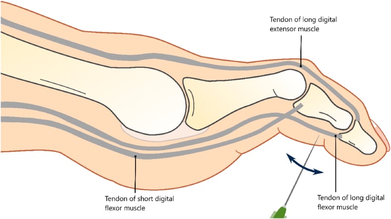 Diagram of percutaneous needle flexor tenotomy of a lesser toe
