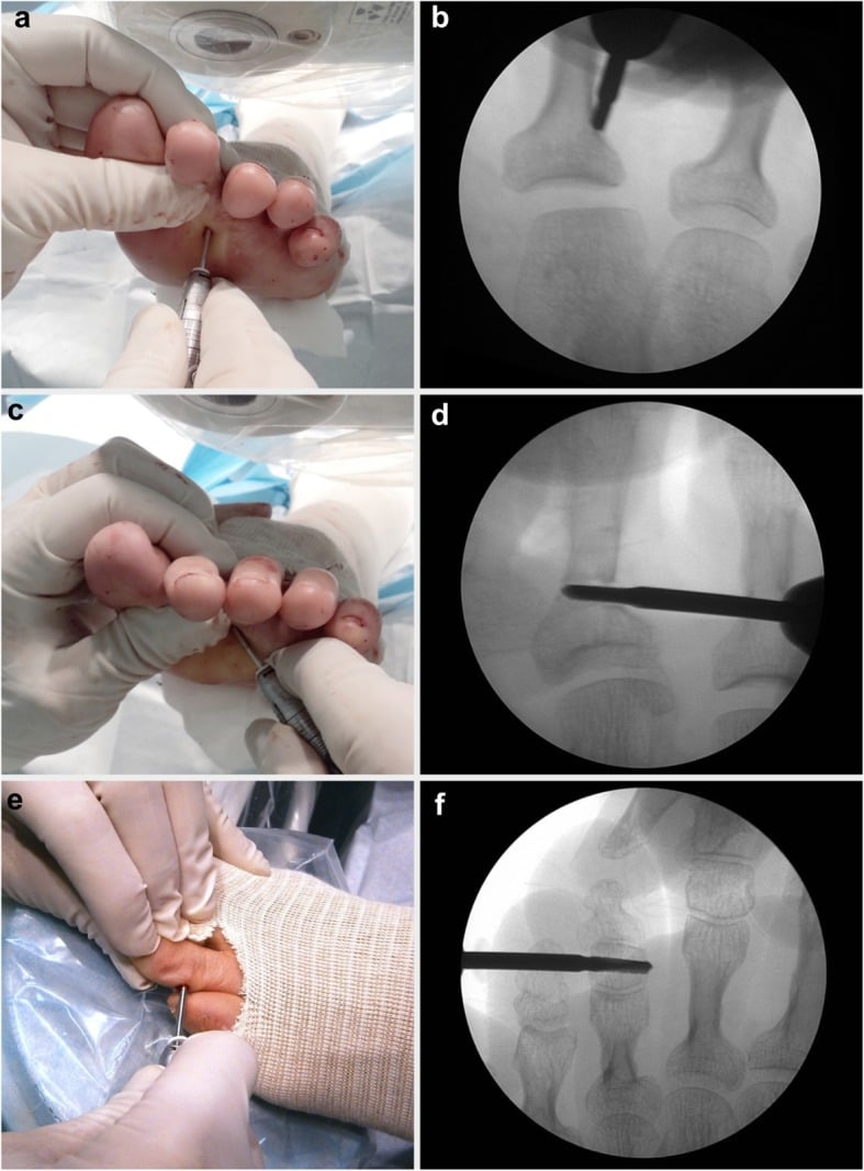 Percutaneous phalangeal osteotomies of the lesser toes under fluoroscopy