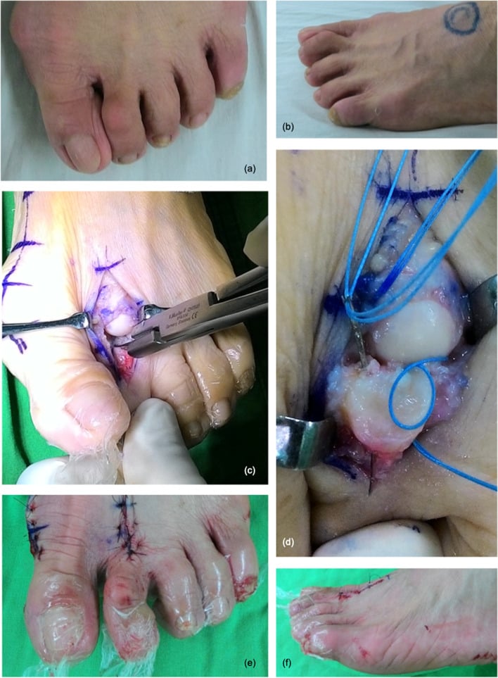 Clinical and operative sequence for lesser-MTP plantar-plate repair