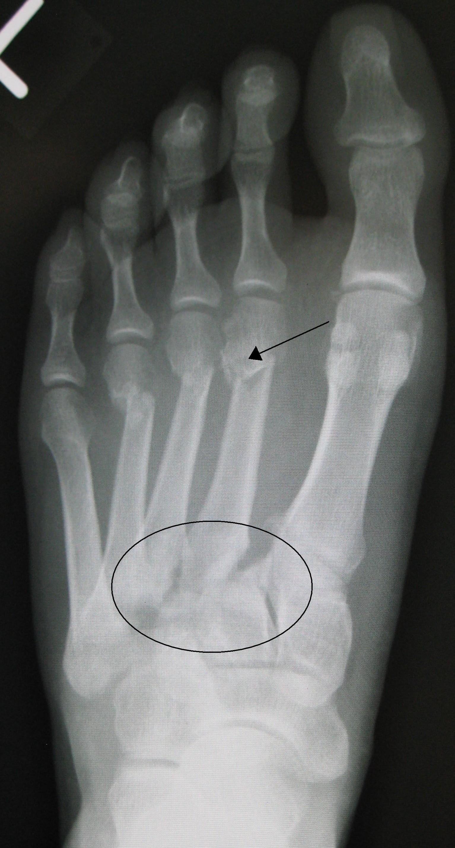 AP foot radiograph at the Lisfranc (tarsometatarsal) joint with arrow and circle marking the second metatarsal base region