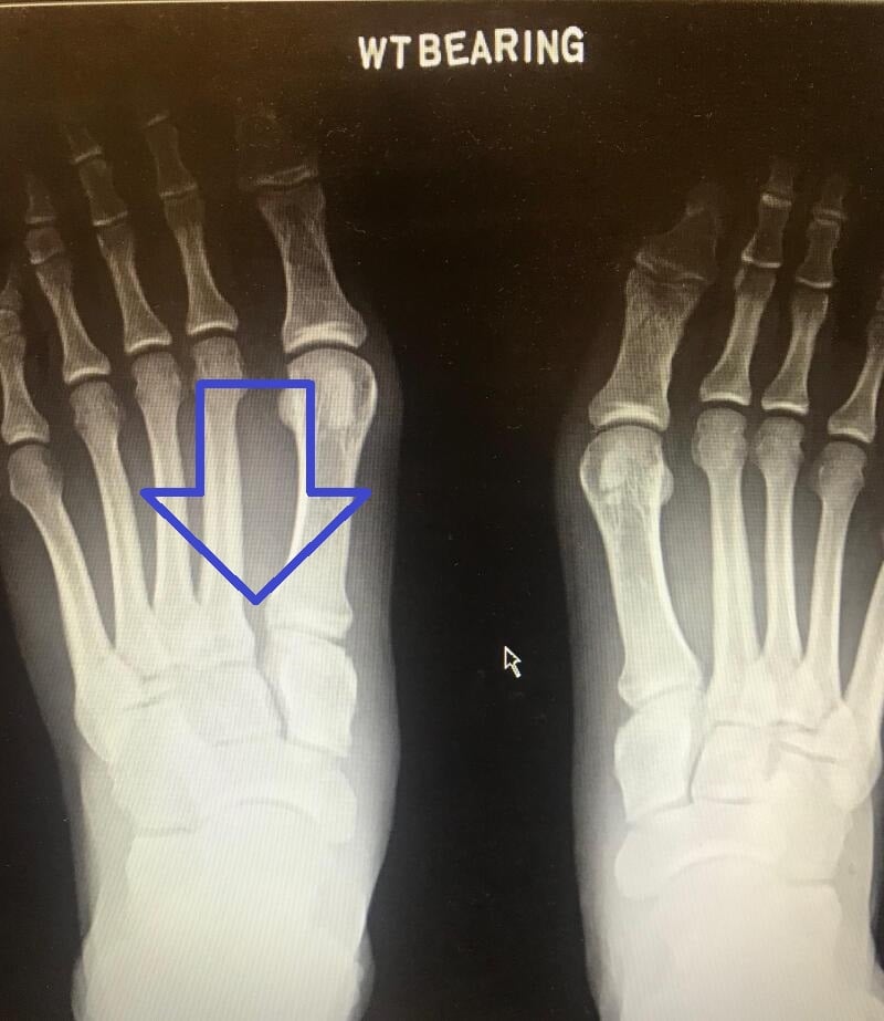 Bilateral weight-bearing AP foot radiographs showing diastasis between the first and second metatarsal bases on the injured side