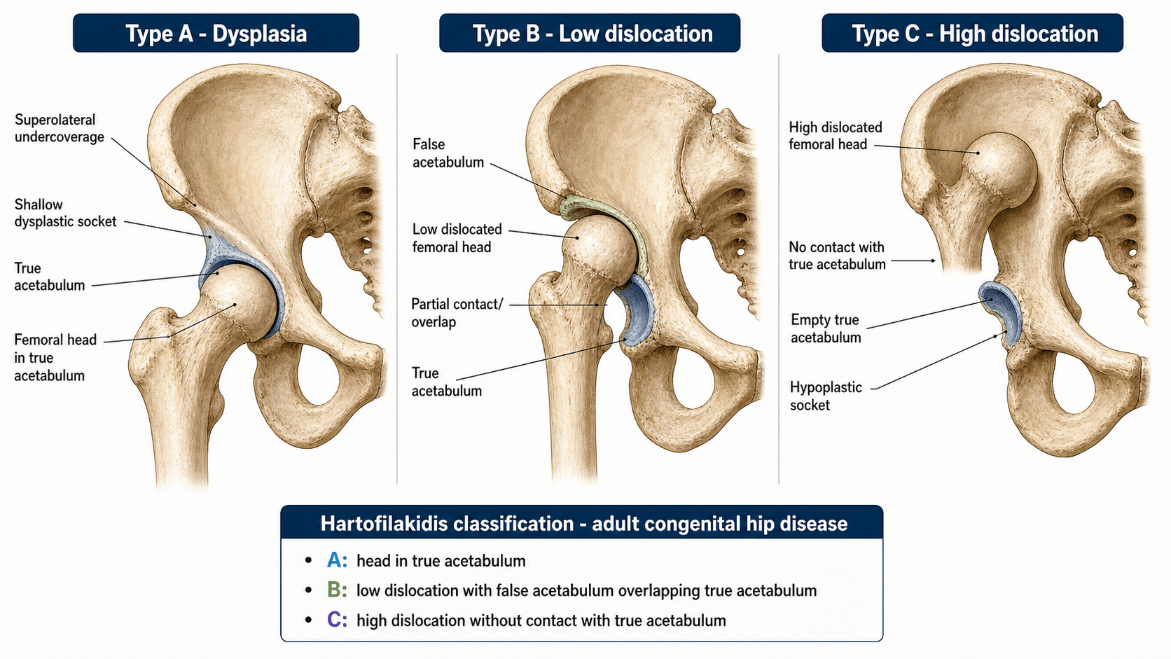Three-panel hemipelvis diagram of the Hartofilakidis types of adult congenital hip disease