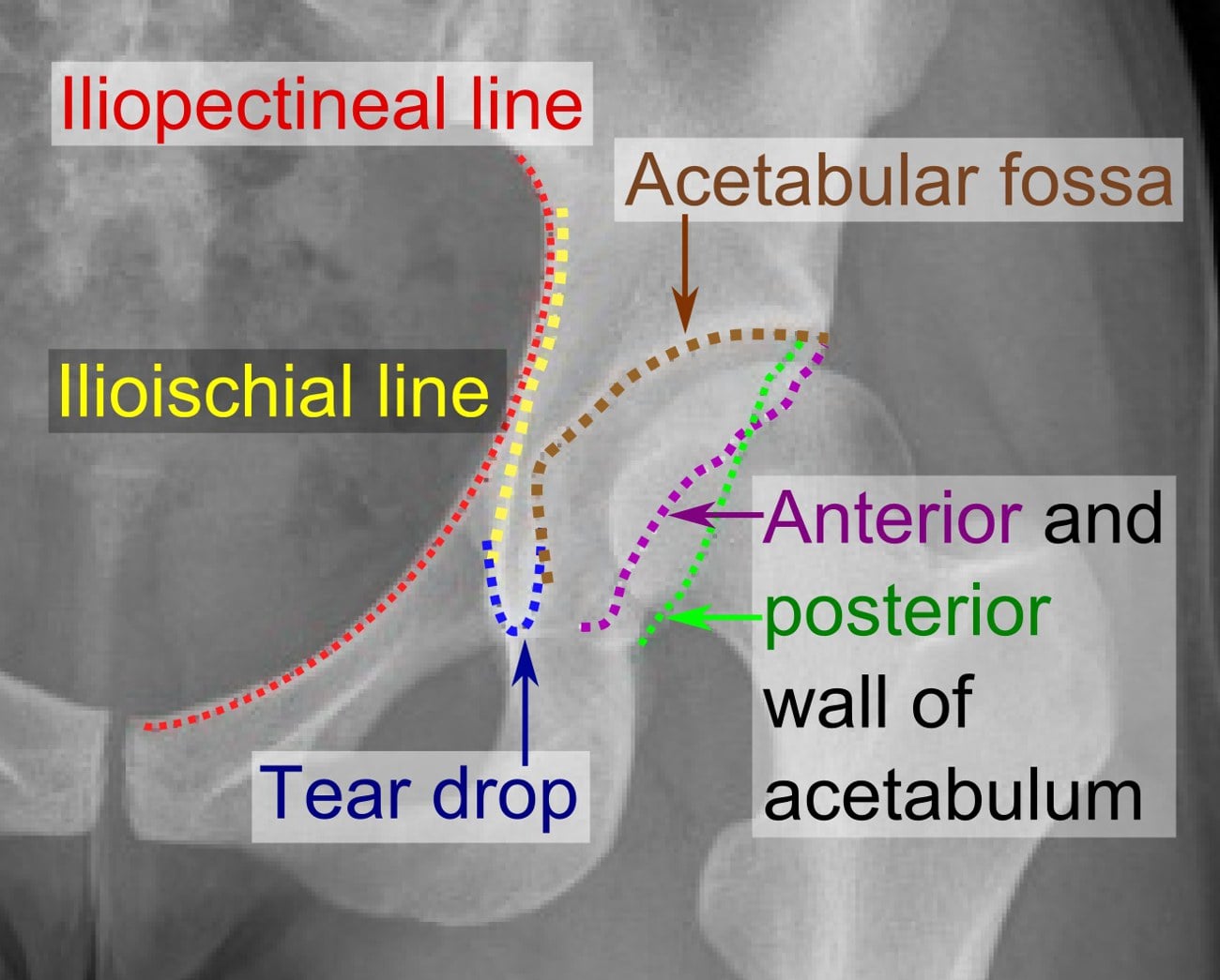 Labeled AP hip radiograph showing the iliopectineal line, ilioischial line, acetabular fossa, tear drop, and anterior and posterior acetabular walls.