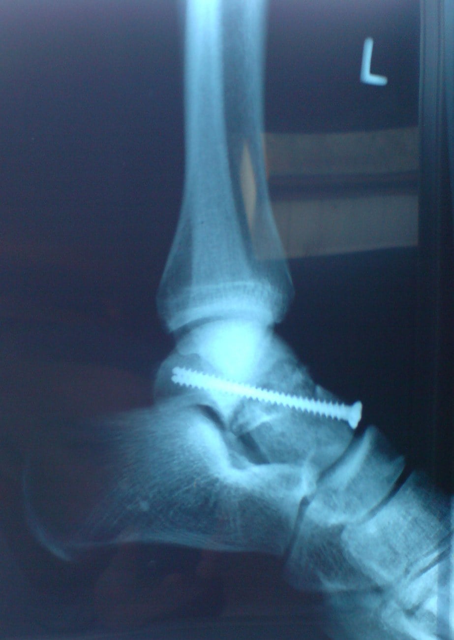 Lateral ankle radiograph after fixation of a talar neck fracture with an anteroposterior compression screw.