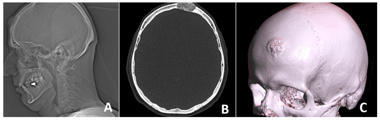 Lateral skull radiograph, axial CT and 3D CT reconstruction of a round frontal-bone haemangioma