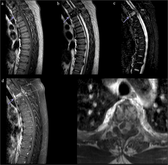 Sagittal MRI panels a to d and an axial image of an aggressive epithelioid haemangioma at T3