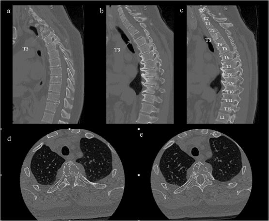 Sagittal and axial CT showing an osteolytic T3 vertebral-body lesion in an epithelioid haemangioma