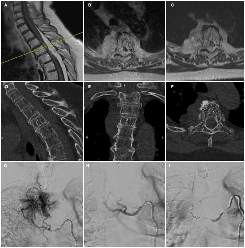 MRI, CT and catheter angiography of a hypervascular vertebral haemangioma, panels A to I