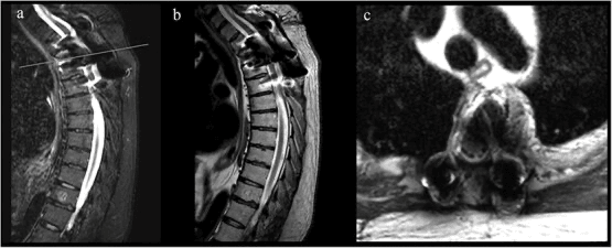 Postoperative sagittal and axial MRI after decompression and stabilisation of an aggressive vertebral haemangioma