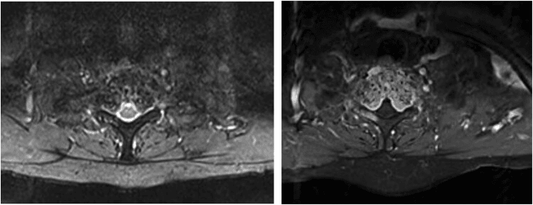 Two axial MRI images of an aggressive vertebral haemangioma filling the vertebral body