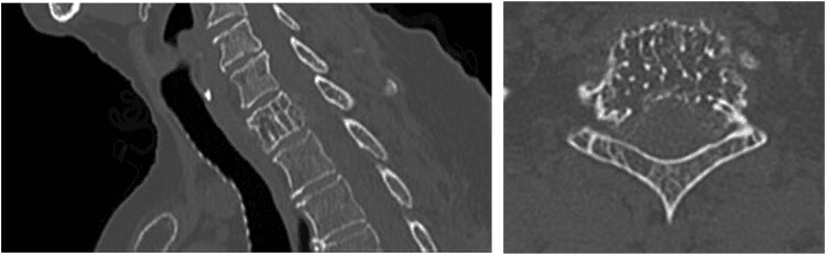 Sagittal and axial CT of a vertebral haemangioma, the axial image showing thickened trabeculae as dots across the vertebral body