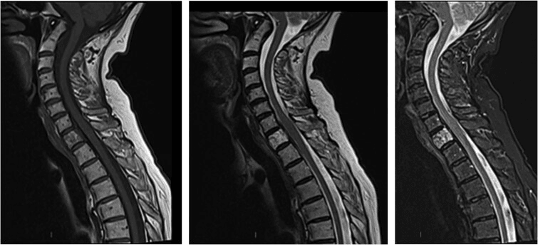 Sagittal T1, T2 and STIR MRI of the cervicothoracic spine with a vertebral haemangioma that is not bright on T1