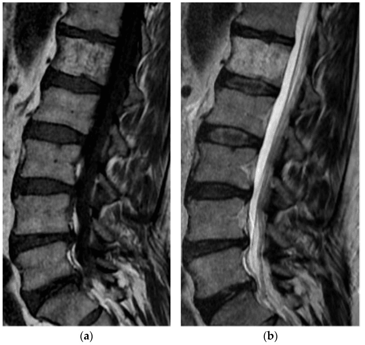 Sagittal T1 and T2 lumbar MRI with a vertebral body bright on both sequences