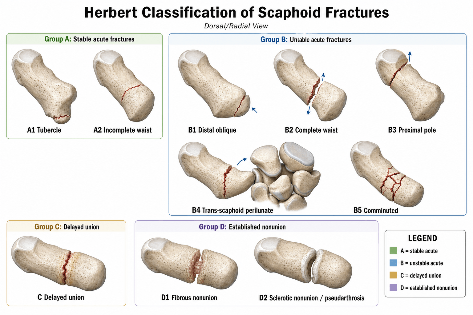 Herbert Classification of Scaphoid Fractures