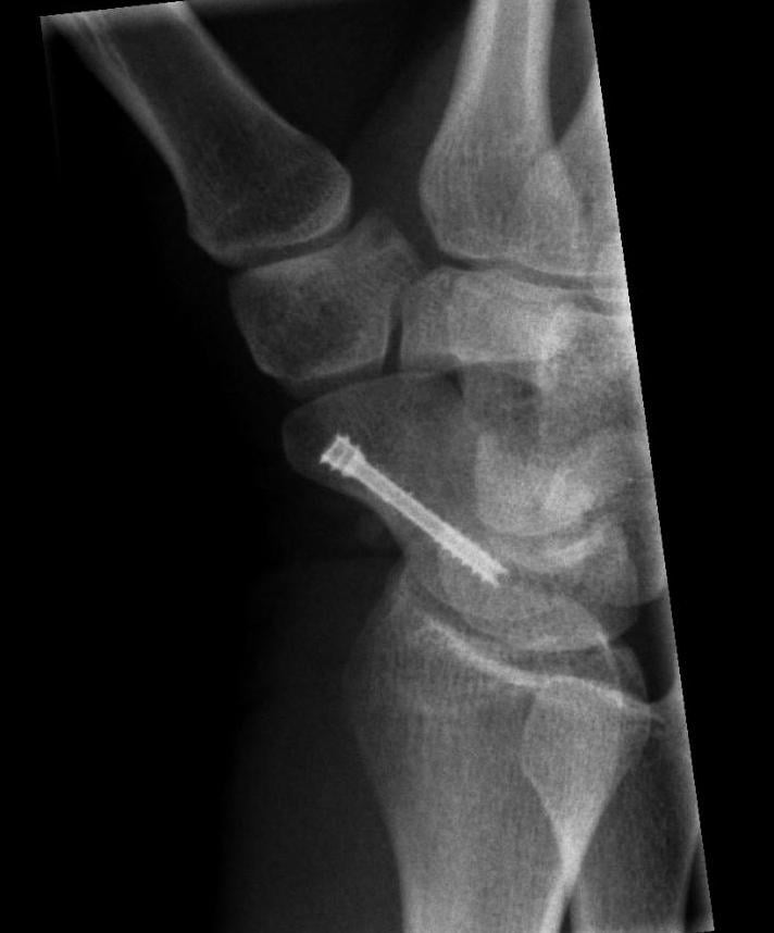 Wrist radiograph showing a headless compression screw running along the long axis of the scaphoid after fixation of a scaphoid fracture.