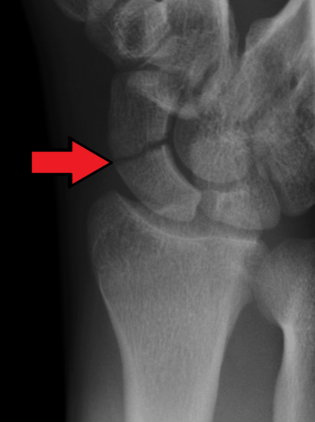 PA wrist radiograph showing a transverse scaphoid waist fracture marked by an arrow.