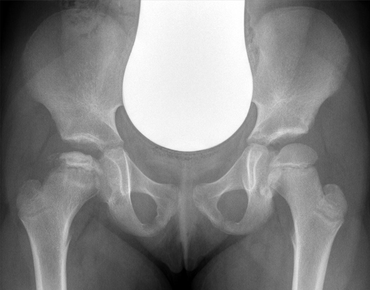 AP pelvis of a child with Legg-Calvé-Perthes disease of the right hip in the fragmentation stage.